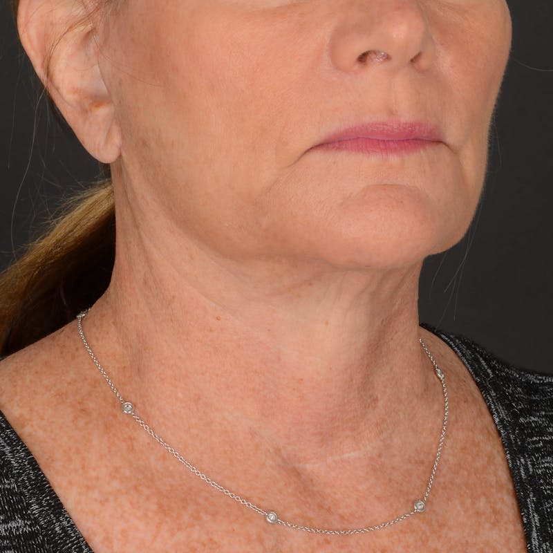 Neck Lift Before & After Gallery - Patient 428356 - Image 2