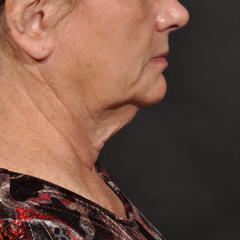 Neck Lift Before & After Gallery - Patient 428356 - Image 3