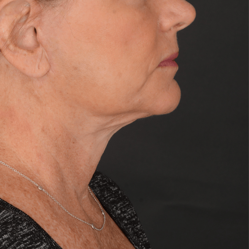 Neck Lift Before & After Gallery - Patient 428356 - Image 4
