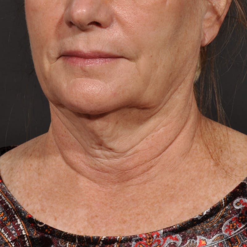 Neck Lift Before & After Gallery - Patient 428356 - Image 5