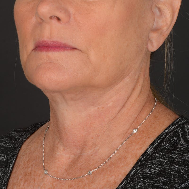 Neck Lift Before & After Gallery - Patient 428356 - Image 6