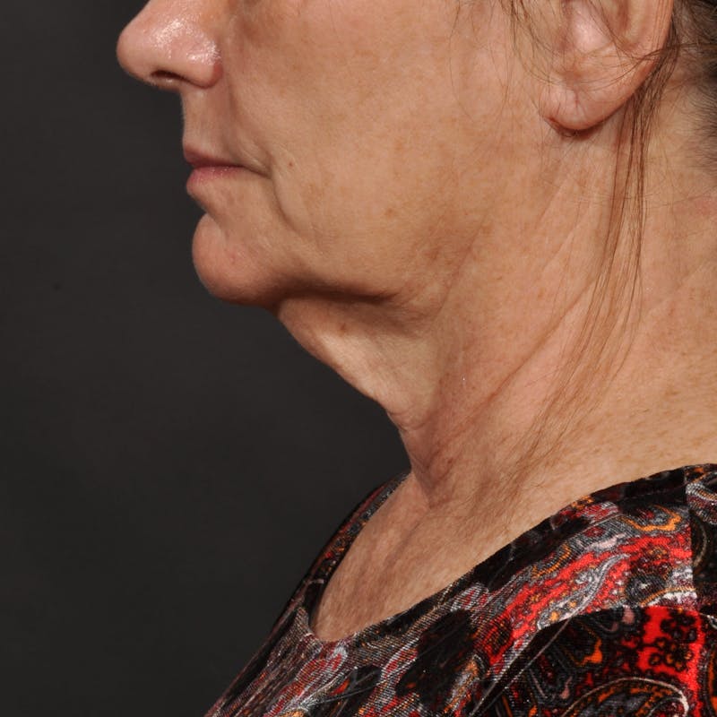 Neck Lift Before & After Gallery - Patient 428356 - Image 7