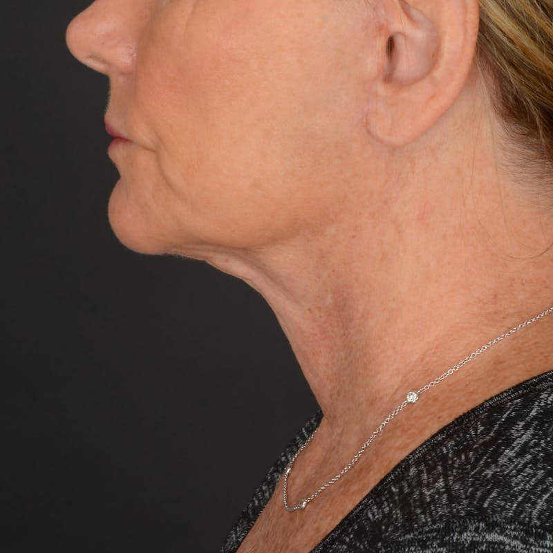 Neck Lift Before & After Gallery - Patient 428356 - Image 8