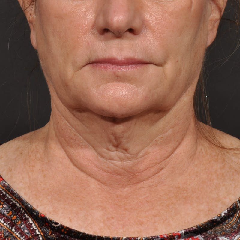 Neck Lift Before & After Gallery - Patient 428356 - Image 9