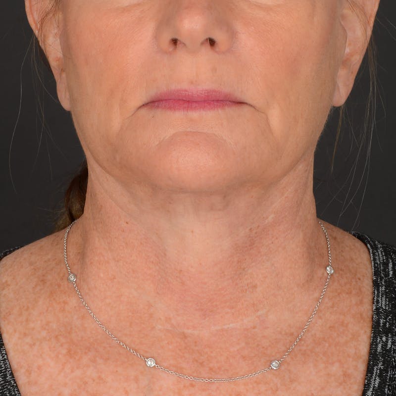 Neck Lift Before & After Gallery - Patient 428356 - Image 10