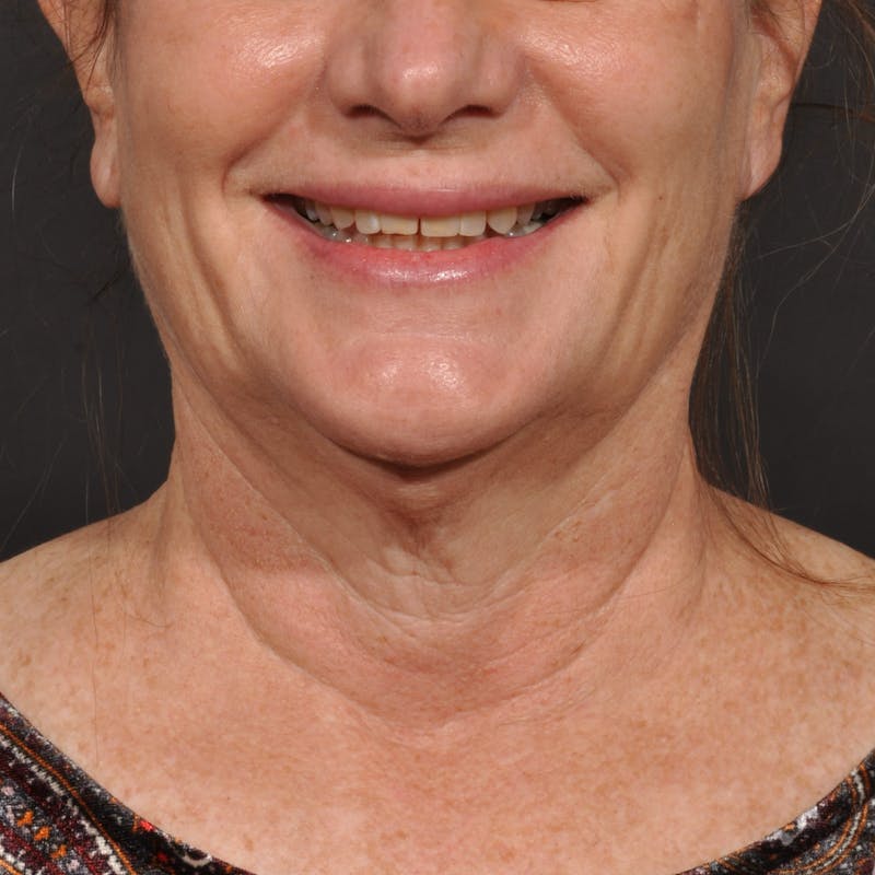 Neck Lift Before & After Gallery - Patient 428356 - Image 11