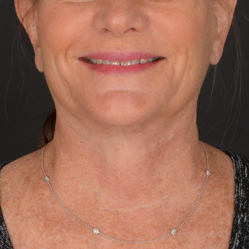 Neck Lift Before & After Gallery - Patient 428356 - Image 12