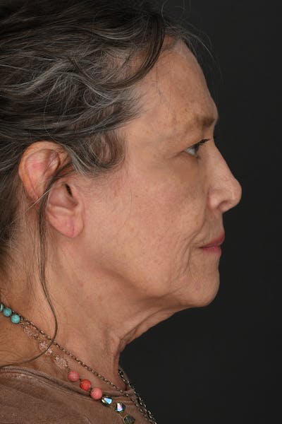 Rhinoplasty Before & After Gallery - Patient 658898 - Image 2
