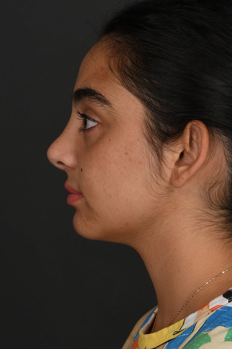 Rhinoplasty Before & After Gallery - Patient 407447 - Image 2