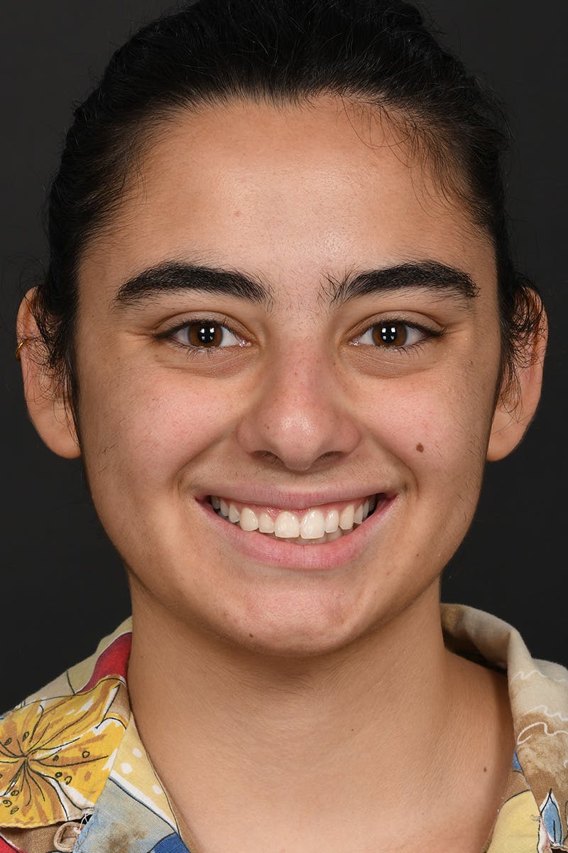 Rhinoplasty Before & After Gallery - Patient 407447 - Image 3