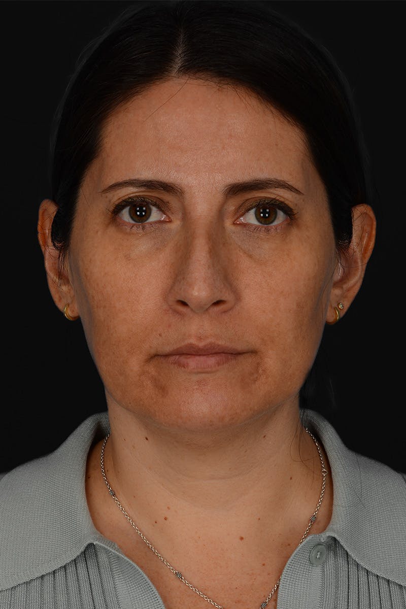 Rhinoplasty Before & After Gallery - Patient 365626 - Image 3