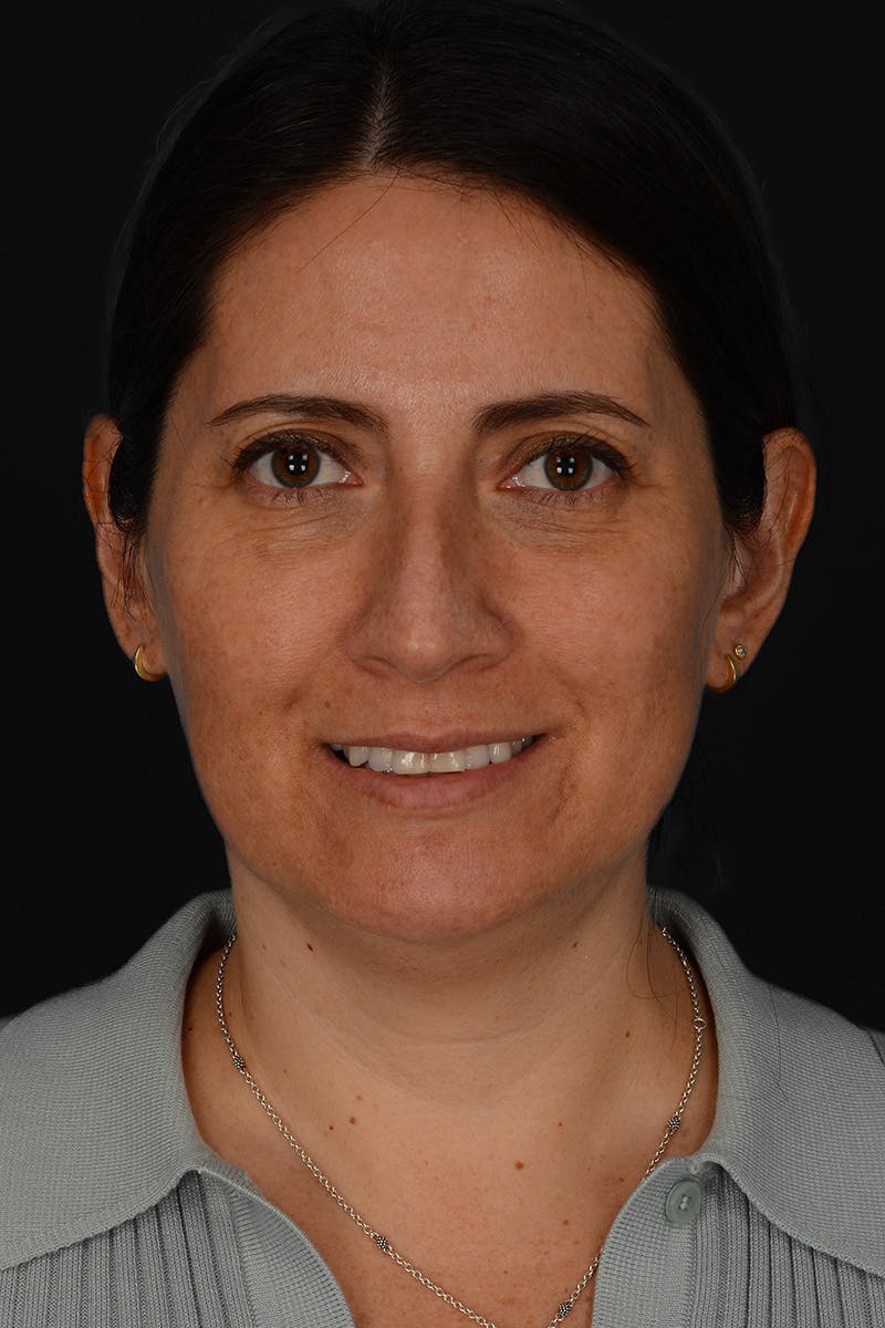 Rhinoplasty Before & After Gallery - Patient 365626 - Image 5