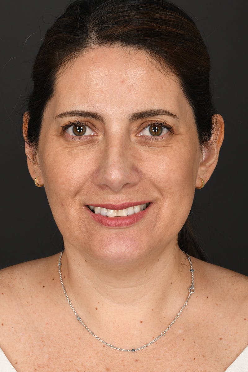 Rhinoplasty Before & After Gallery - Patient 365626 - Image 6