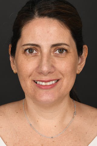 Rhinoplasty Before & After Gallery - Patient 365626 - Image 6