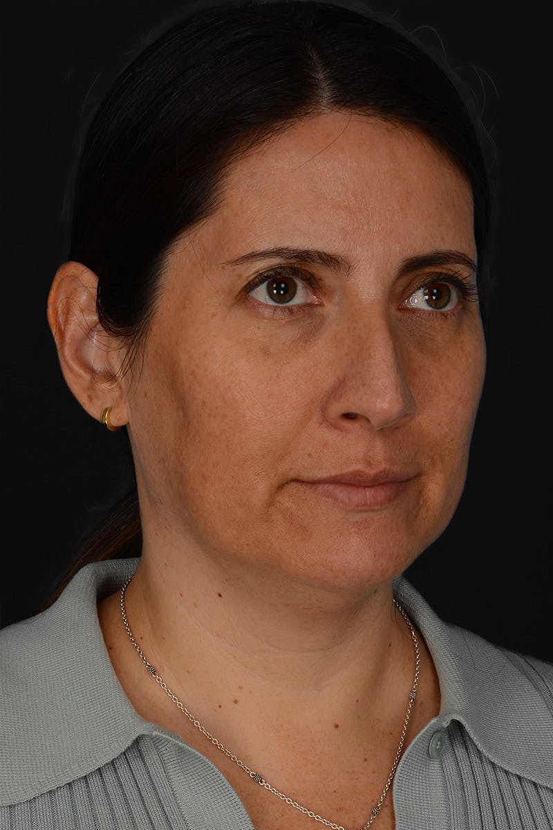 Rhinoplasty Before & After Gallery - Patient 365626 - Image 7