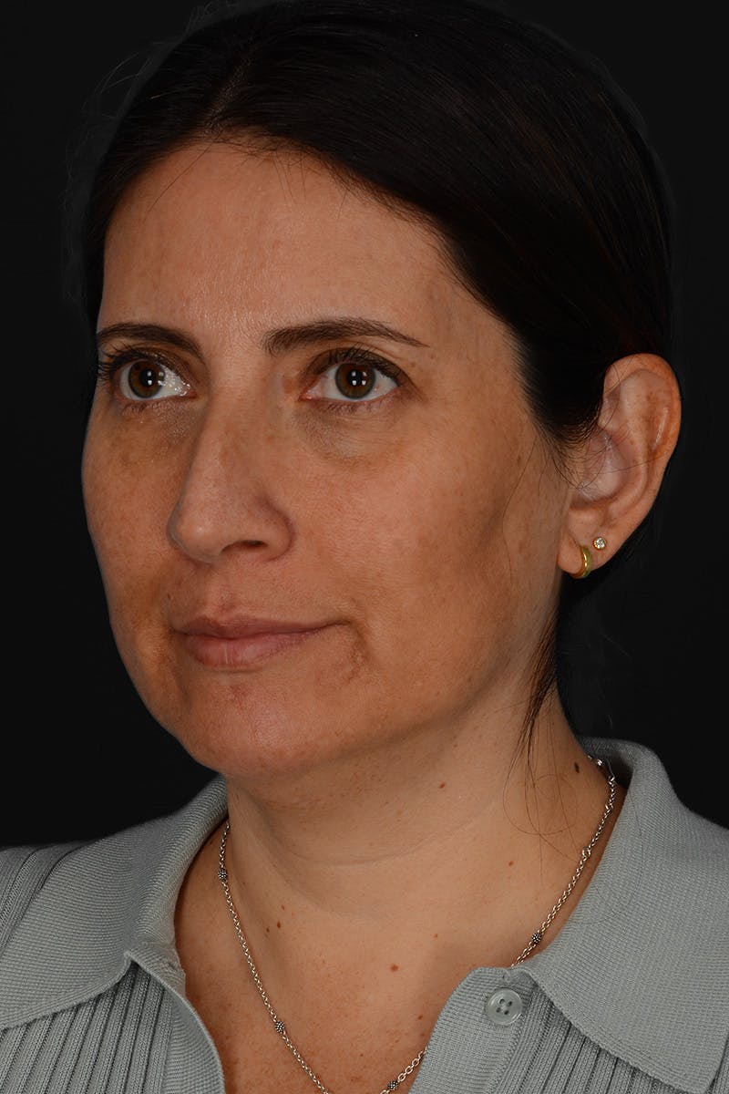 Rhinoplasty Before & After Gallery - Patient 365626 - Image 11