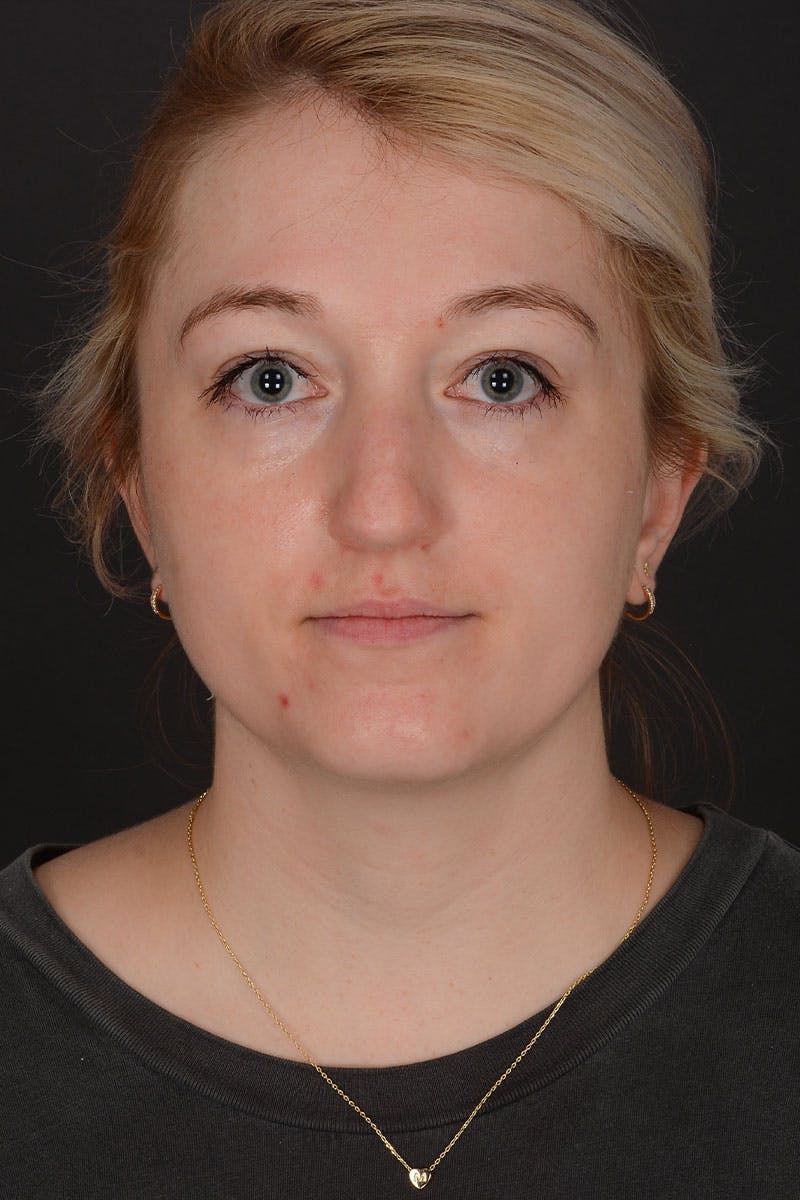 Rhinoplasty Before & After Gallery - Patient 232636 - Image 3