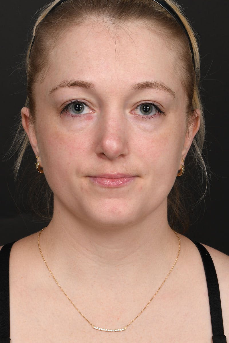 Rhinoplasty Before & After Gallery - Patient 232636 - Image 4