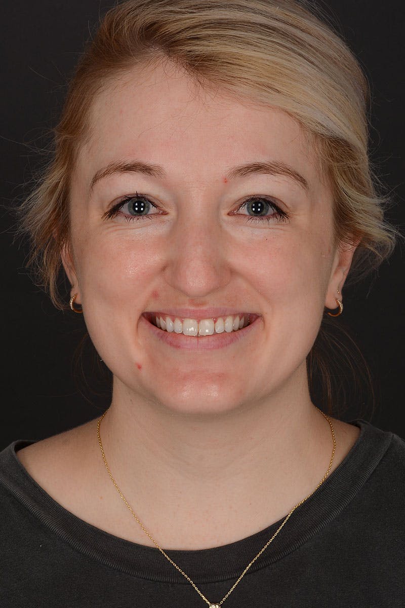 Rhinoplasty Before & After Gallery - Patient 232636 - Image 5