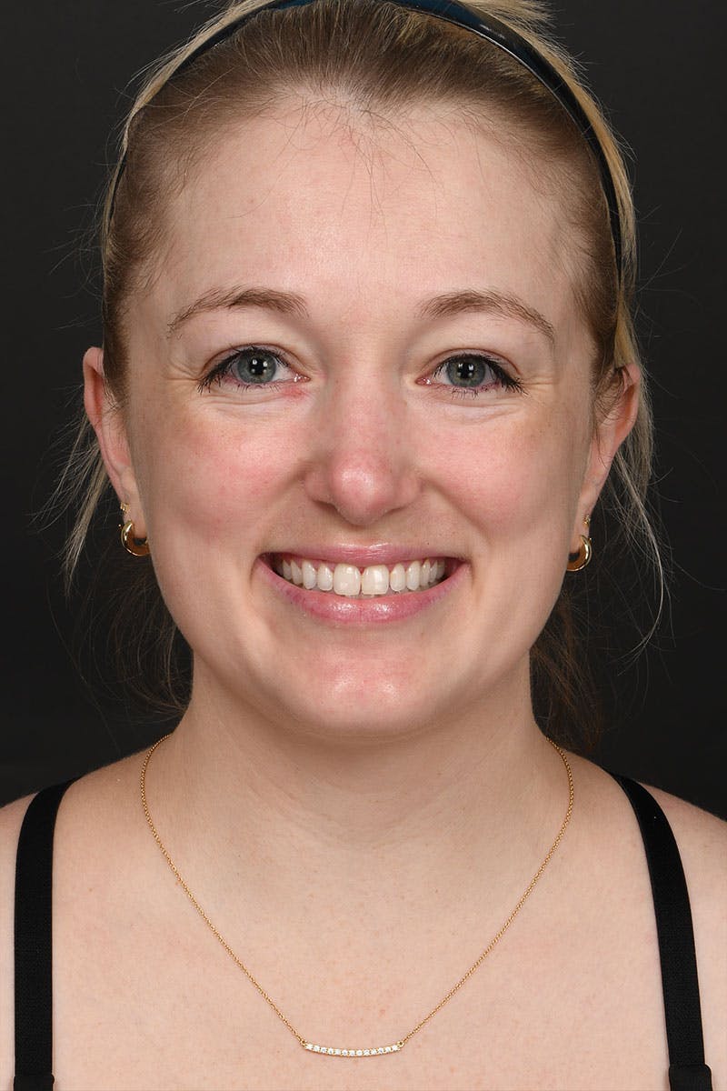 Rhinoplasty Before & After Gallery - Patient 232636 - Image 6