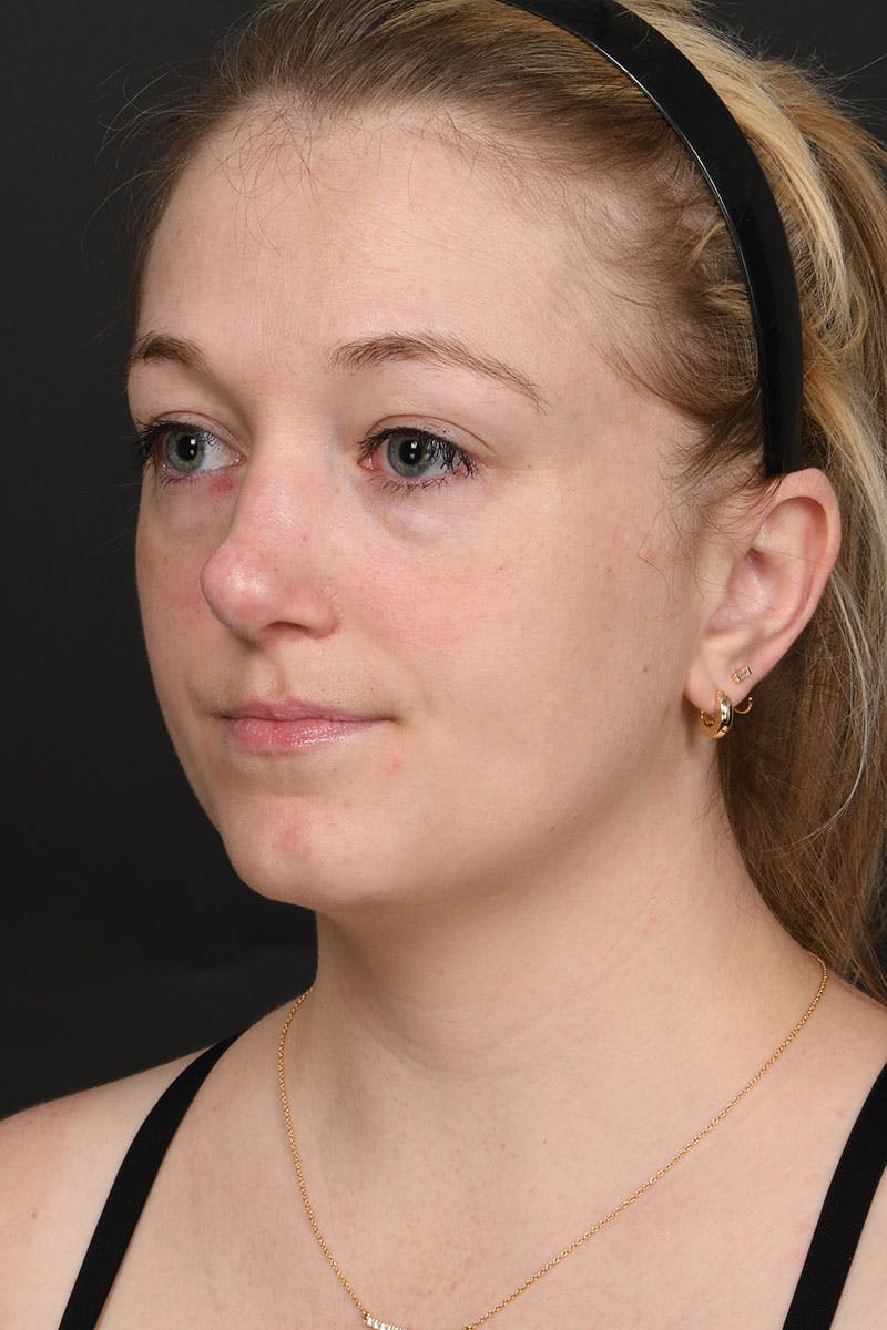 Rhinoplasty Before & After Gallery - Patient 232636 - Image 8