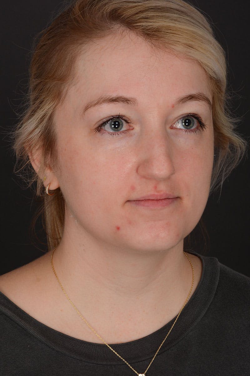 Rhinoplasty Before & After Gallery - Patient 232636 - Image 9