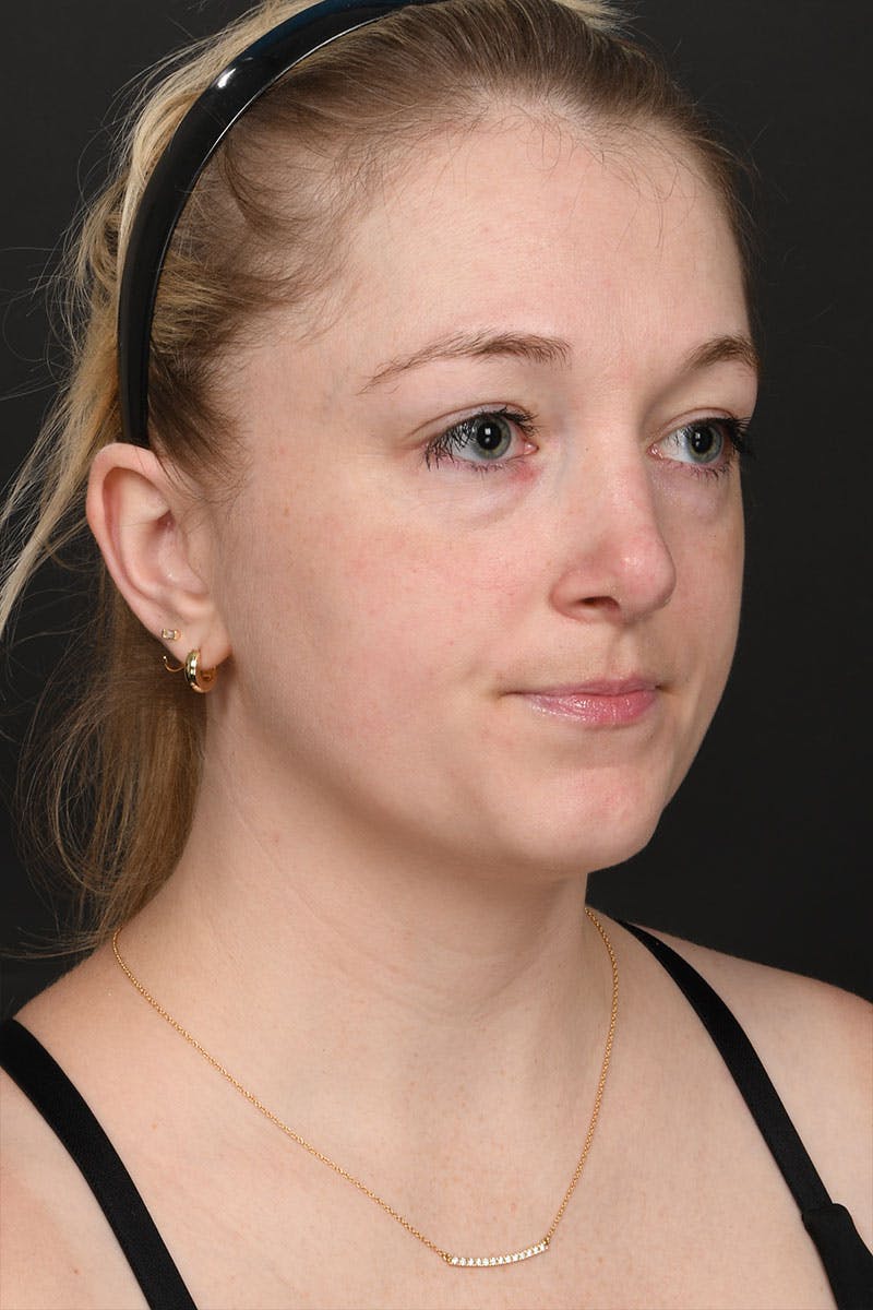 Rhinoplasty Before & After Gallery - Patient 232636 - Image 10