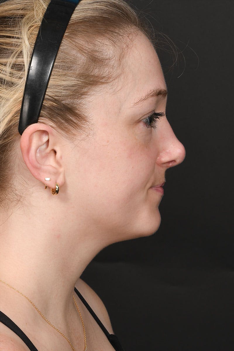 Rhinoplasty Before & After Gallery - Patient 232636 - Image 12