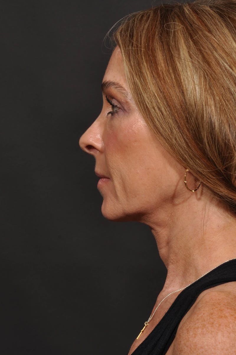 Rhinoplasty Before & After Gallery - Patient 123066 - Image 1