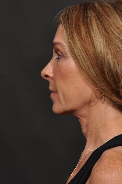 Rhinoplasty Before & After Gallery - Patient 123066 - Image 1