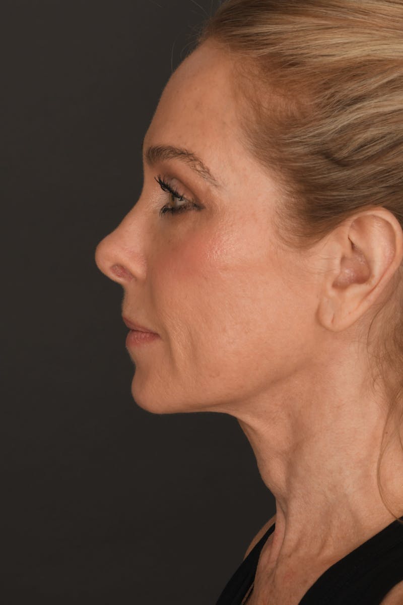 Rhinoplasty Before & After Gallery - Patient 123066 - Image 2