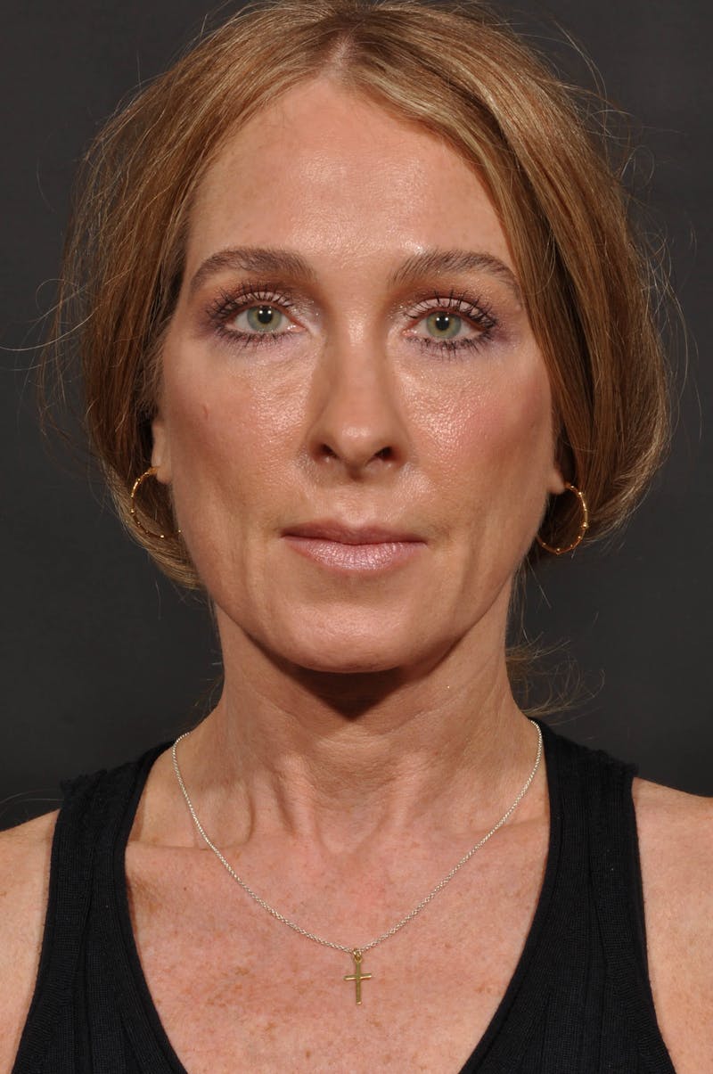 Rhinoplasty Before & After Gallery - Patient 123066 - Image 3