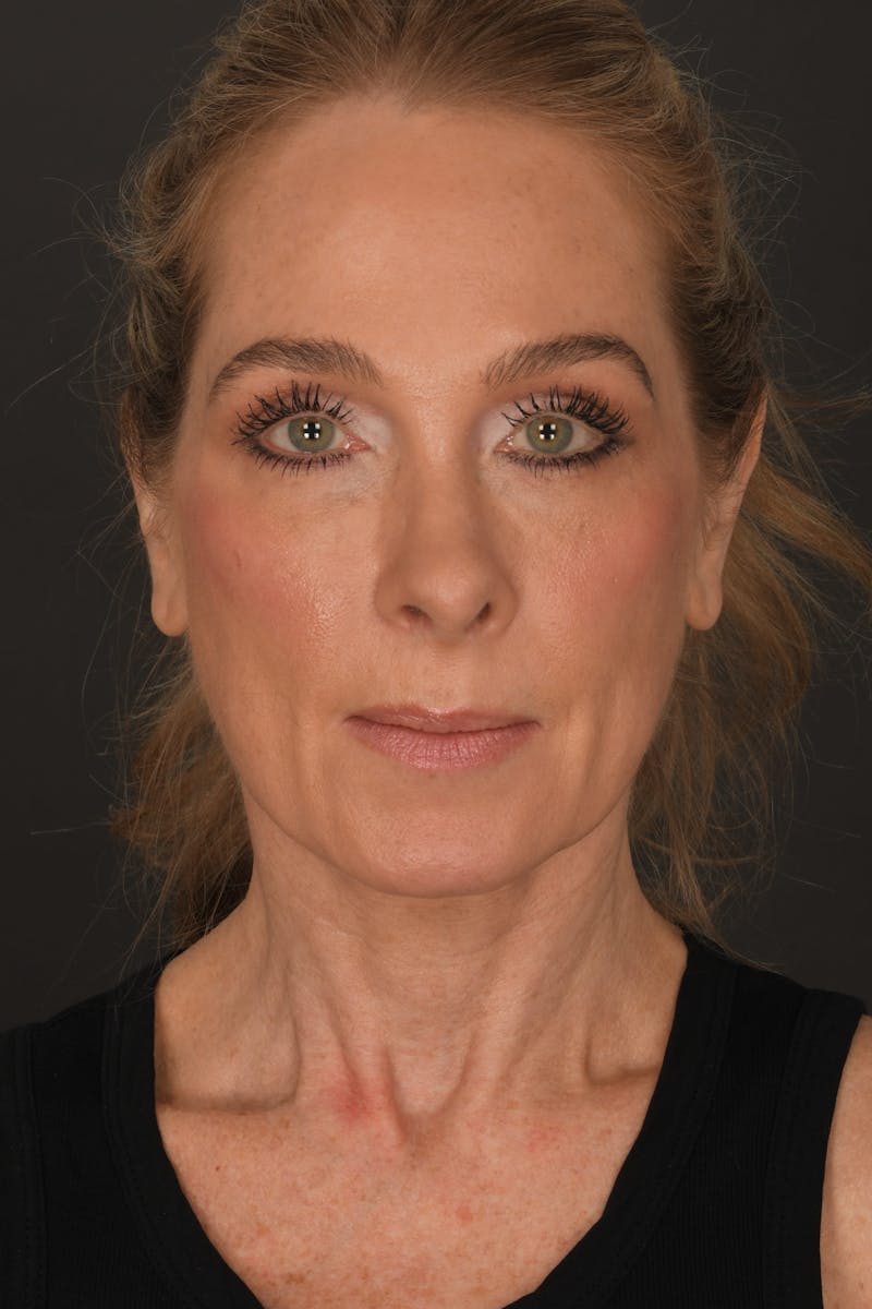 Rhinoplasty Before & After Gallery - Patient 123066 - Image 4