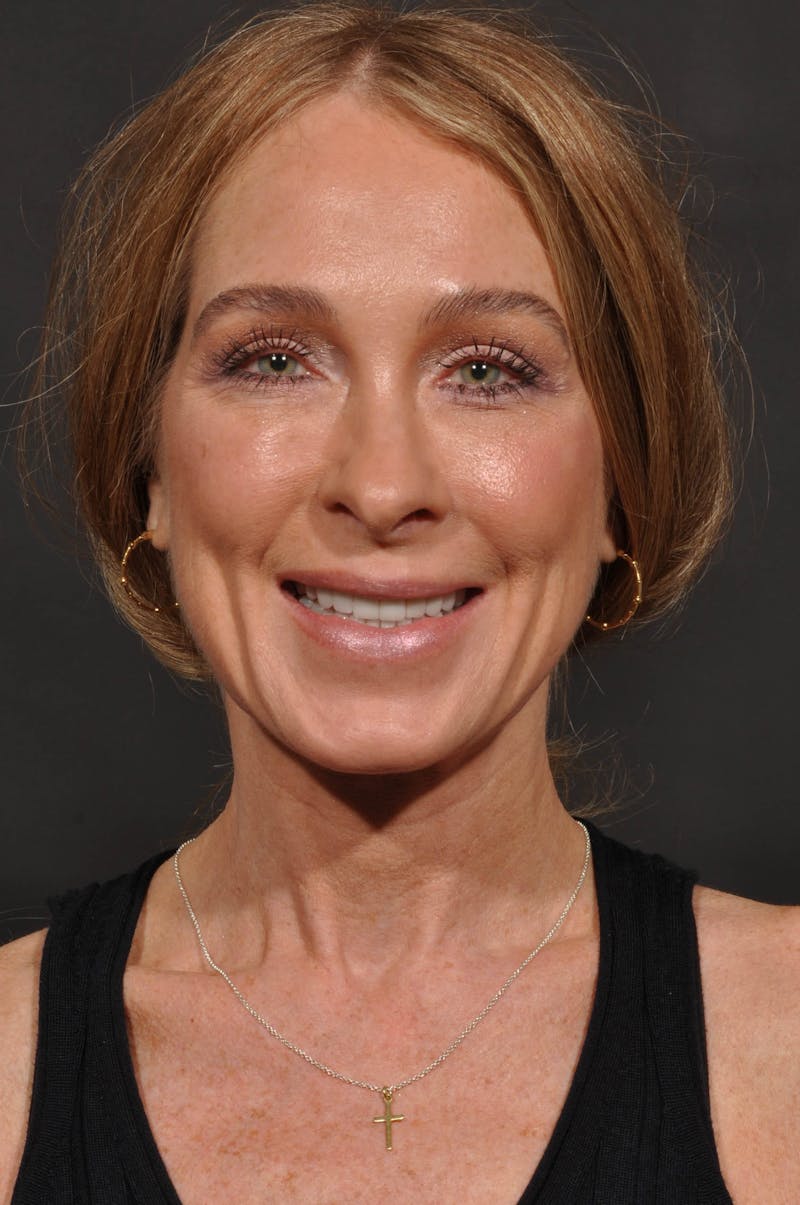 Rhinoplasty Before & After Gallery - Patient 123066 - Image 5