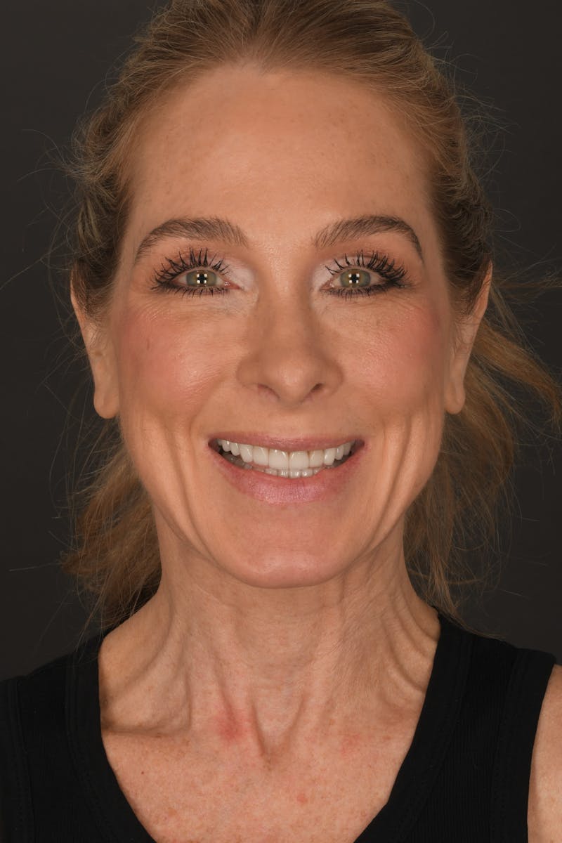 Rhinoplasty Before & After Gallery - Patient 123066 - Image 6