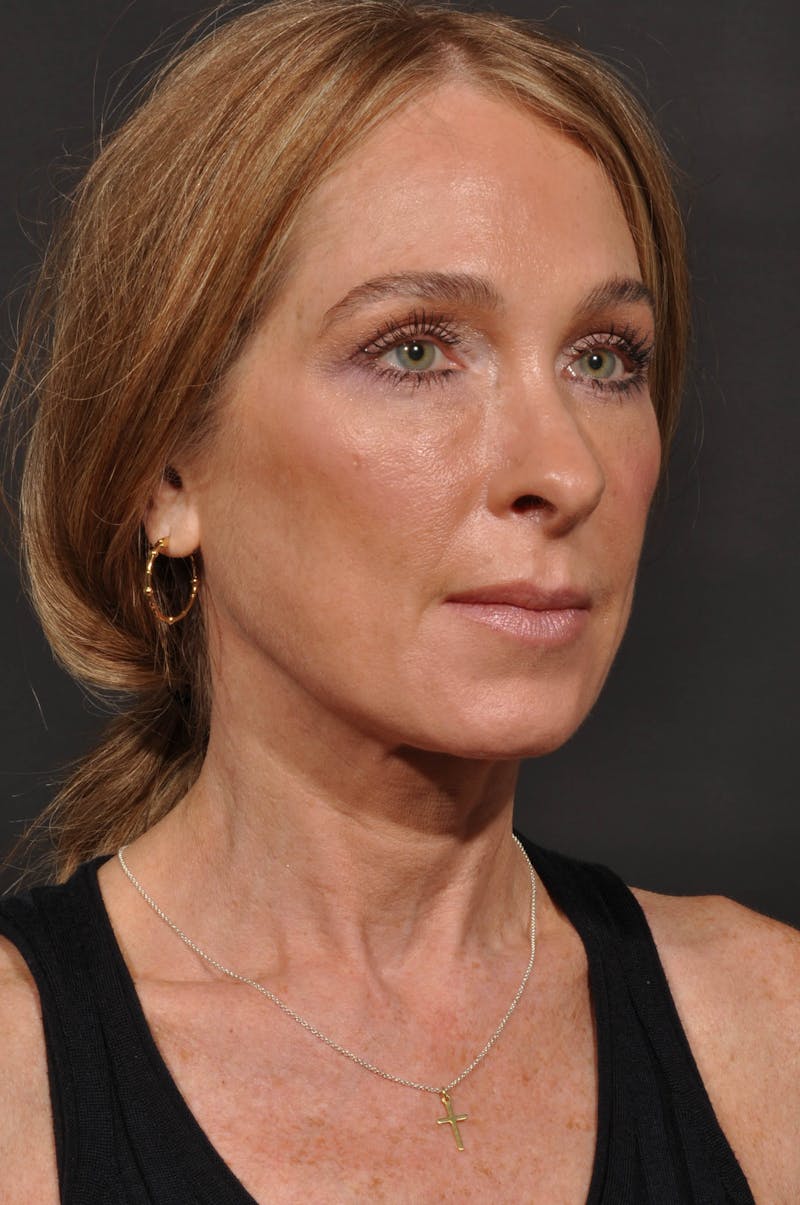 Rhinoplasty Before & After Gallery - Patient 123066 - Image 9