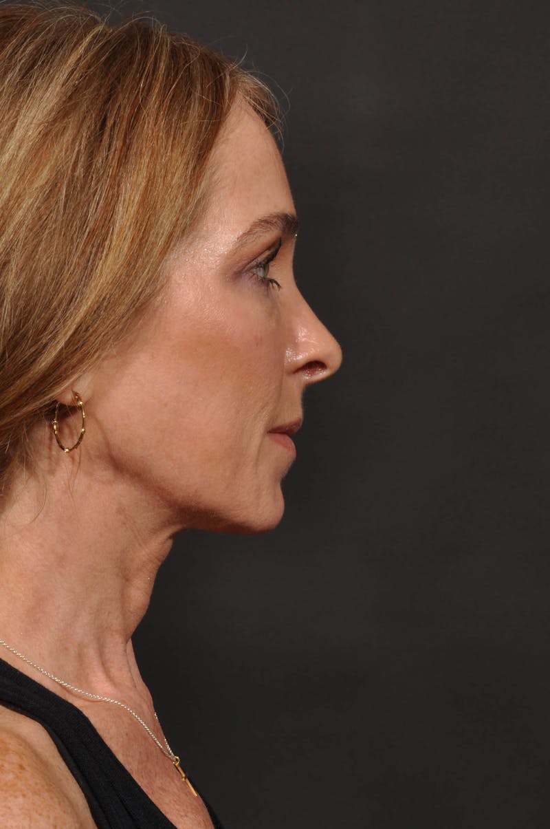 Rhinoplasty Before & After Gallery - Patient 123066 - Image 11