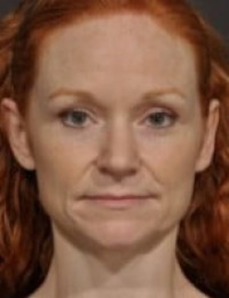 Rhinoplasty Before & After Gallery - Patient 349230 - Image 2