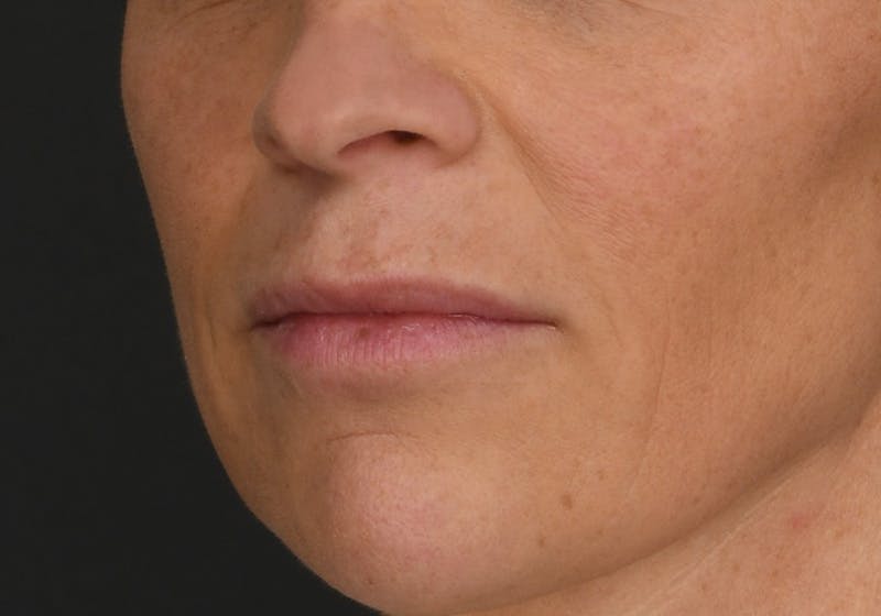 Lip Lift Before & After Gallery - Patient 590410 - Image 1