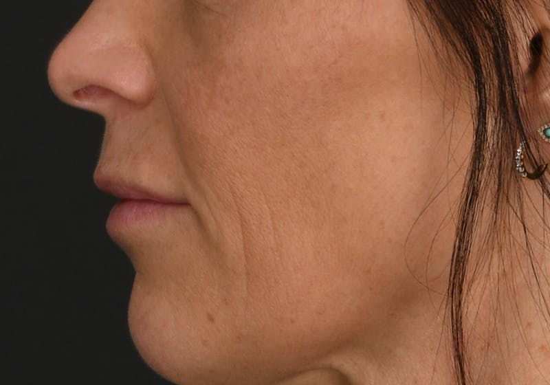 Lip Lift Before & After Gallery - Patient 590410 - Image 3