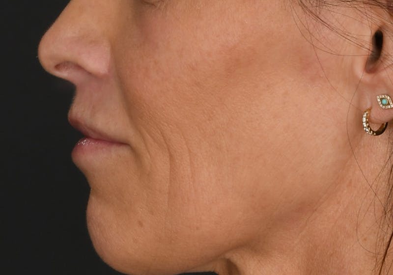 Lip Lift Before & After Gallery - Patient 590410 - Image 4