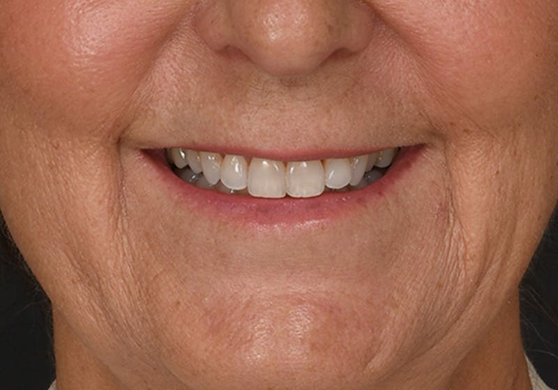 Lip Lift Before & After Gallery - Patient 630023 - Image 1