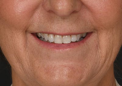 Lip Lift Before & After Gallery - Patient 630023 - Image 1