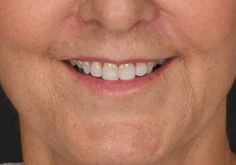 Lip Lift Before & After Gallery - Patient 630023 - Image 2