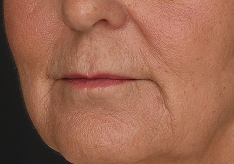 Lip Lift Before & After Gallery - Patient 630023 - Image 3