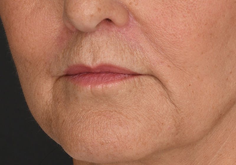 Lip Lift Before & After Gallery - Patient 630023 - Image 4