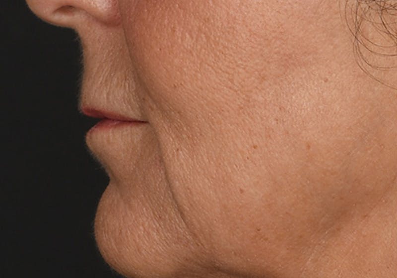 Lip Lift Before & After Gallery - Patient 630023 - Image 5