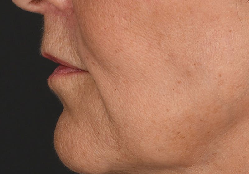 Lip Lift Before & After Gallery - Patient 630023 - Image 6