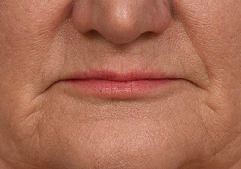 Lip Lift Before & After Gallery - Patient 295227 - Image 1