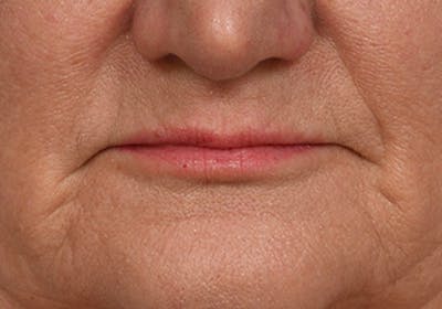 Lip Lift Before & After Gallery - Patient 295227 - Image 1
